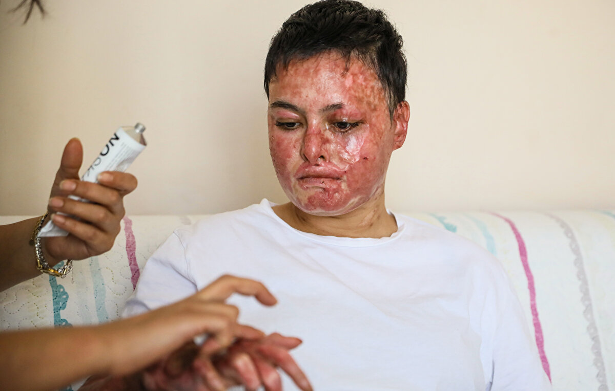 Olayın yaşandığı iş yerinden davacı olan Hatmorioğlu, bir yandan da ilaç ve egzersiz ile kaza öncesindeki sağlığına dönmeye çalışıyor. Okulunu tamamlayıp, üniversitede aynı işi yapacağı mesleği seçmek istediğini söyleyen Beyzanur, tedavisinin ardından sanayiye dönerek işini yapmak istiyor.