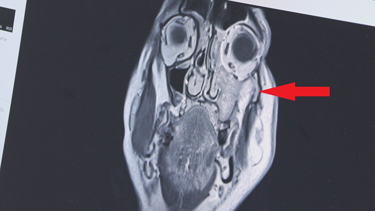 "SİNÜZİTLE DE KARIŞABİLİYOR"<br>Prof. Dr. Apuhan, şu bilgileri verdi: "Hastamız diş yakınması nedeniyle başka bir merkezde diş hekimine gidiyor. Oradan bize yönlendirildi. Endoskopik olarak muayene ettik ve burnun sol tarafında bir kitle ile karşılaştık. Daha sonra yaptığımız görüntüleme tetkiklerinde yüzün sol tarafında maksiller ve etmoid sinüs dediğimiz bölümü dolduran, göze ve beyin dokusuna kadar uzanım olan bir kitleyle karşılaştık. Ameliyatta özellikle sol tarafta damak bölgesinin göze ve beyne yakın bölgelerini de temizledik. Gözü koruduk. Tümörün geliştiği anatomik bölgenin karmaşık olmasından dolayı hastalık çok geç fark ediliyor ve başka hastalıklarla karıştırılabiliyor. Bizlere de çok geç ulaşıyorlar. Özellikle tek taraflı burun tıkanıklığı, kanaması olan, yüzün bir tarafında uyuşma hissi, şişlik, yüzde asimetri, geçmeyen baş ağrısı gibi şikayetleri olan hastaların vakit geçirmeden mutlaka KBB hastalıkları ve baş boyun cerrahisi uzmanına gitmesini öneriyoruz"