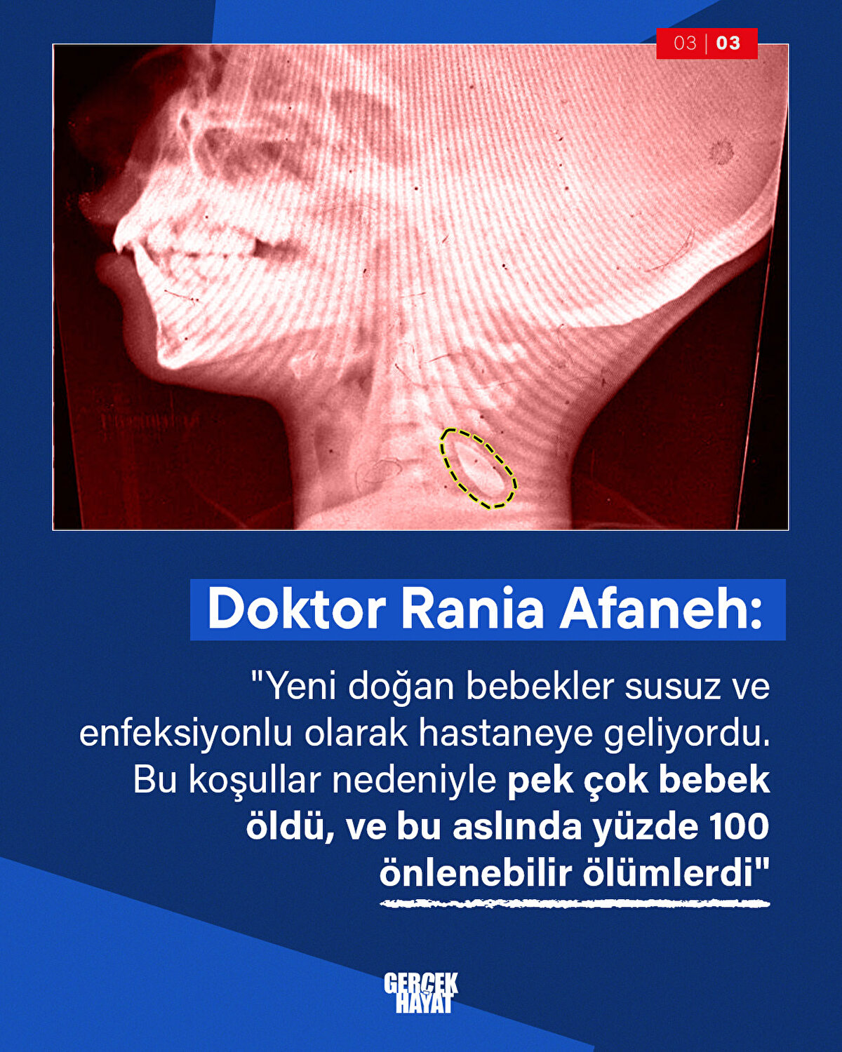 Doktor Arham Ali: "Yeni doğan bebekler susuz ve enfeksiyonlu olarak hastaneye geliyordu. Bu koşullar nedeniyle pek çok bebek öldü, ve bu aslında yüzde 100 önlenebilir ölümlerdi"