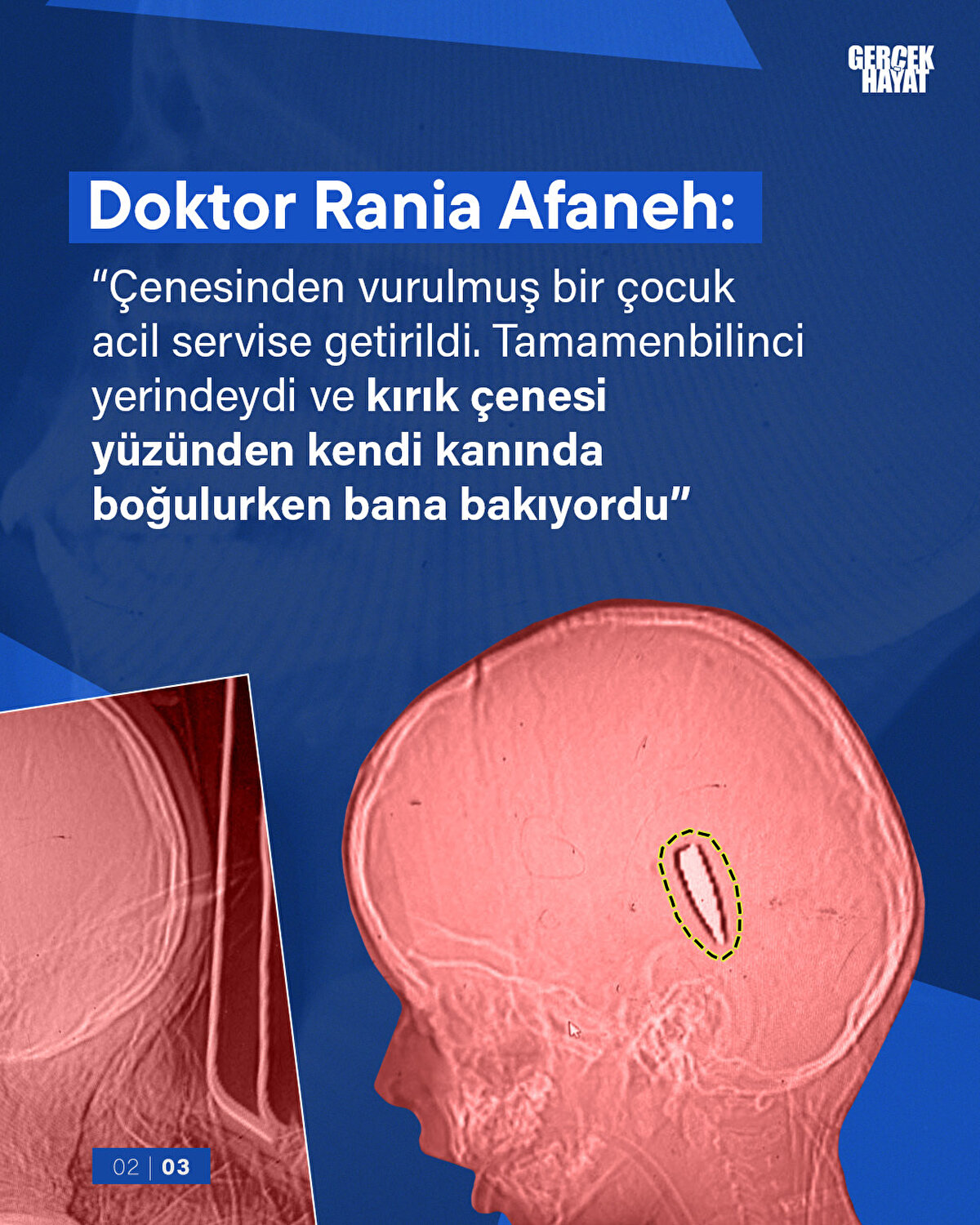 Doktor Rania Afaneh: “Çenesinden vurulmuş bir çocuk acil servise getirildi. Tamamen bilinci yerindeydi ve kırık çenesi yüzünden kendi kanında boğulurken bana bakıyordu”