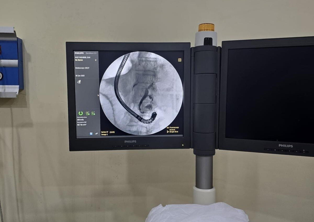 ERCP işlemine dair detaylardan bahseden "Akkuzu, "Binde bir dahi olsa ölümcül riski olan bir işlem. Tabii anatomisi farklı olan hastalarda bu riskler daha fazla oluyor. Çünkü daha önce deneyimlemediğimiz bir işlem. Normal noktada açılmayan safra kanalı, tam tersi tarafında açılıyor. Böyle bir durumda tabii işlemi gerçekleştirmek, işlemin manevraları farklı bir şekilde düşünmek lazım. Normal ERCP işlemi başlı başına bir riskken, anatomisi farklı olan hastalarda daha büyük riskler oluyor. Ama bu hastada ayna görüntüsü gibi düşünerek, farklı manevralar yaparak, kendi deneyimimizi kazandık. Hiçbir komplikasyon gelişmeden, hastanın işlemi başarıyla tamamlandı. Tabii bunun bir makale şeklinde de yazmayı düşünüyoruz. Çünkü buna benzer vakalar varsa meslektaşlarımızın faydalanmasını istiyorum" dedi.