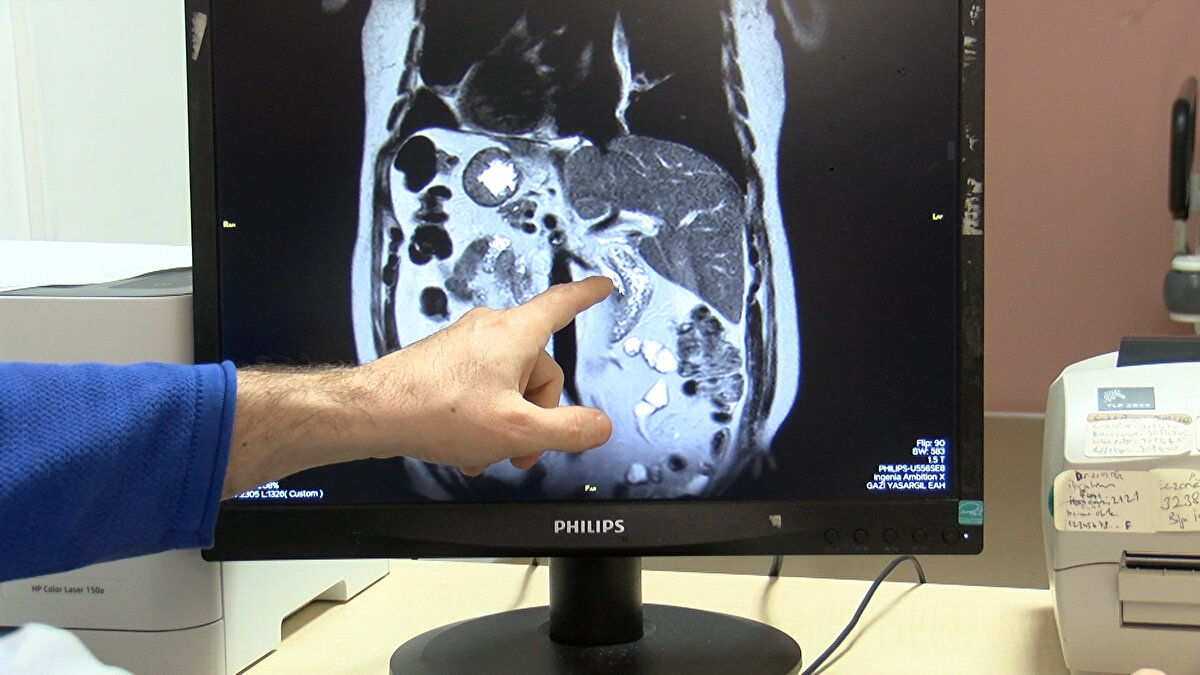 Bağlar ilçesinde yaşayan Mehmet Şükrü Ak, 1999 yılında burun ameliyatı için muayene olduğu hastanede, iç organlarının ters yerde bulunduğunu öğrendi. Yıllarca bu durumdan endişe duymayan Ak, geçen hafta karın ağrısı şikayetiyle Gazi Yaşargil Eğitim ve Araştırma Hastanesi'ne başvurdu. Burada röntgenleri çekilen Ak'ın safra kanalında taşlar olduğu tespit edildi. Gastroenteroloji Uzmanı Dr. Mustafa Zanyar Akkuzu ve ekibi, Mehmet Şükrü Ak'ın safra kanalındaki taşları ERCP işlemi ile çıkarttı. Organları ters olan hastalar için risk taşıyan operasyon sonucu karın ağrısı şikayeti sona eren ve sağlığına kavuşan Ak, 24 saat sonra taburcu edildi.