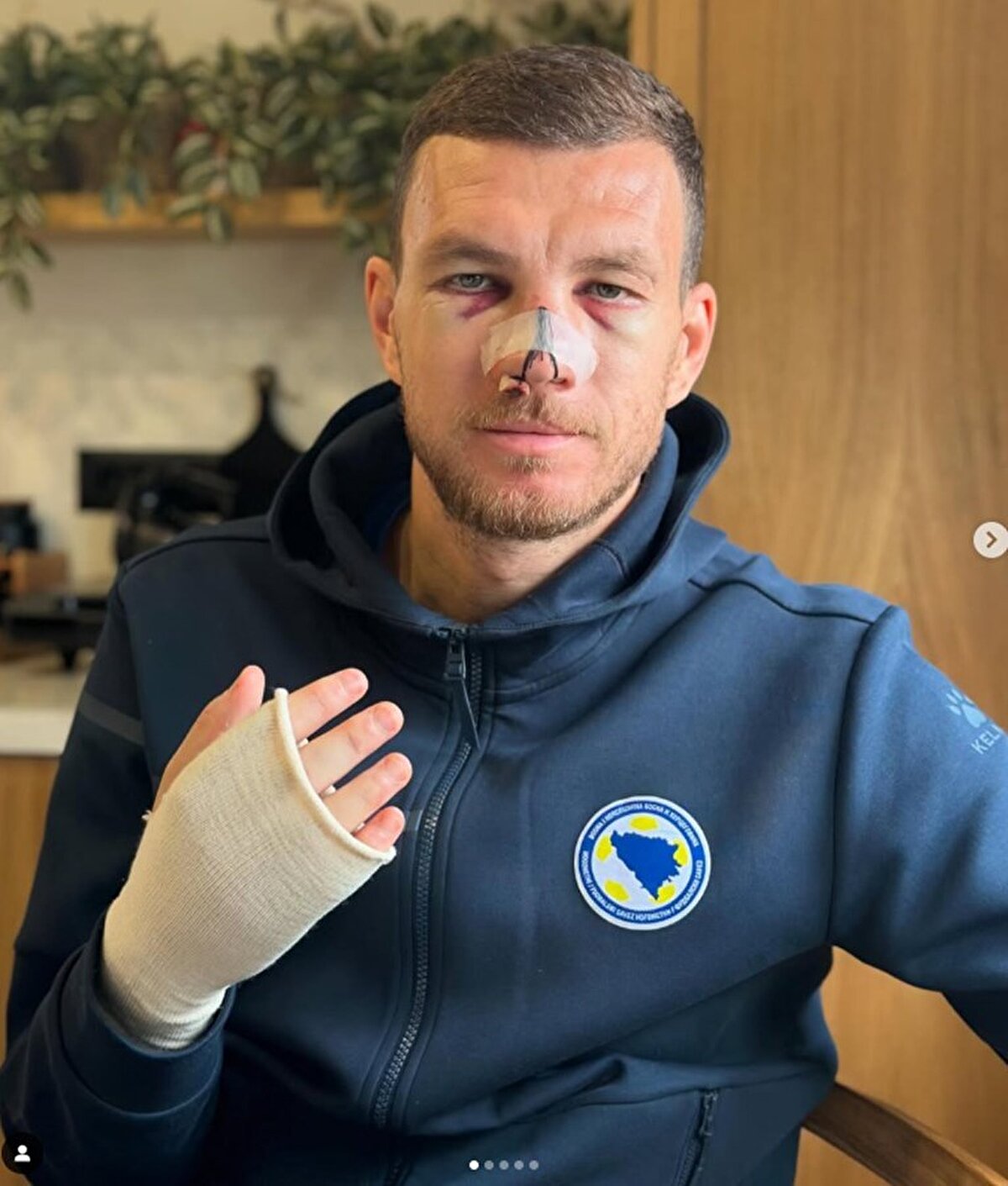 Sosyal medya hesabından, burnunun ve daha önce sakatlık geçirdiği elinin son durumunu paylaşırken, "Ya hepsi ya hiç" ifadelerini kullandı.<br>