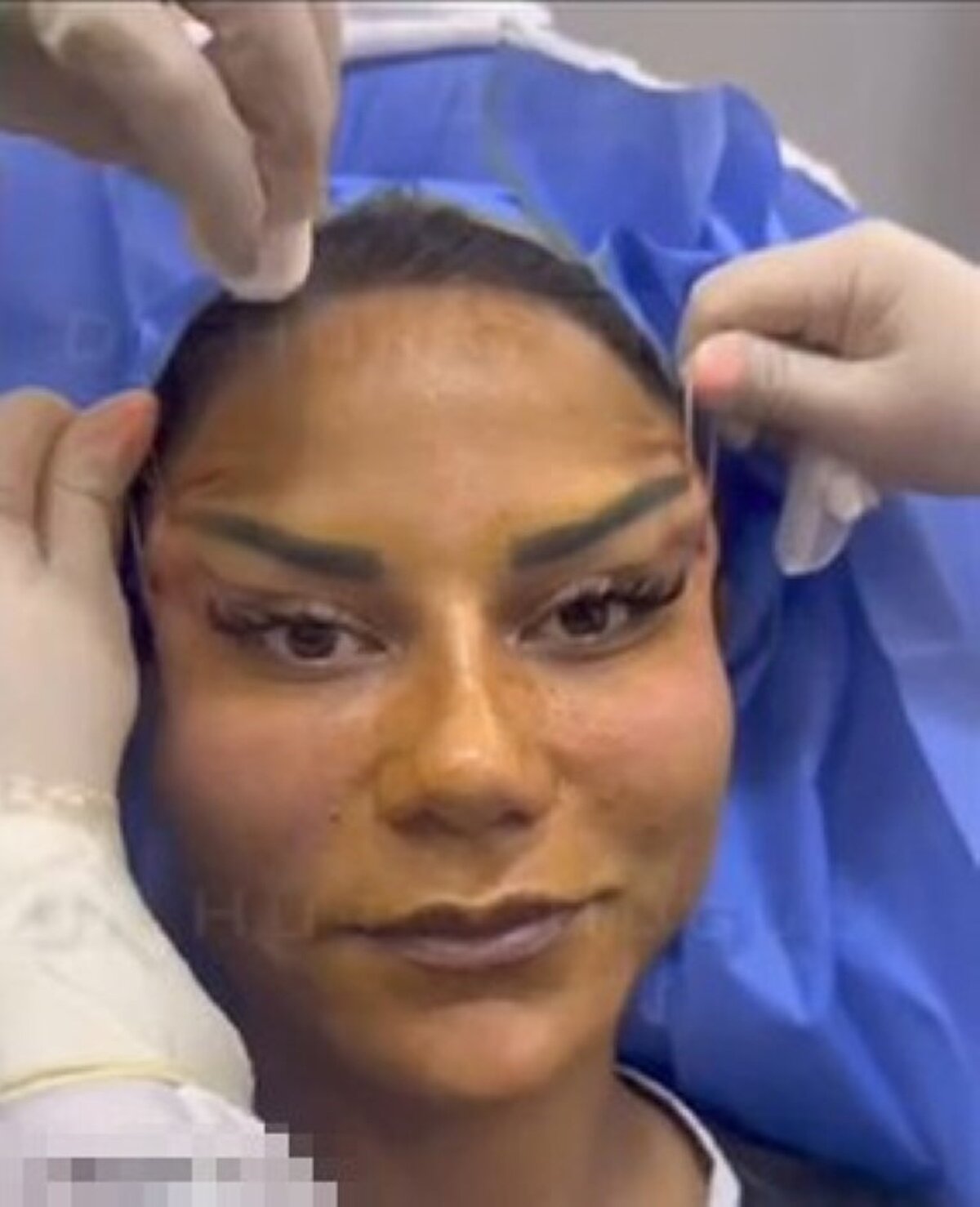 "Özgüvenim ve psikolojim gitti"<br><br>Estetik sürecinden sonra hayatında birçok maddi ve manevi zorluk çektiğini belirten Mert, "Suratımın elastikleri de gitti. Yüz 4 ayda bu şekilde oldu gözümün altları ödem topladı. Özgüvenim ve psikolojim gitti. Bu süreçte ödemelerimi de yapamıyorum. Ciddi anlamda sıkıntıya girdim, kimse girmesin. İnsanların mağduriyetleri giderilmiyor, aldıkları paranın da hakkını vermiyorlar" şeklinde konuştu. Yaşadığı mağduriyetinin giderilmesi için hukuk yolunda savaşacağını ve estetik gibi işlemler yaptırmak isteyen kişilerin önceden çok iyi araştırma yapması gerektiğini vurgulayan Ada Mert, "İyi araştırın, kesinlikle yüklü miktarlarda ödeme yapmayın, imzalattıkları kâğıtları okuyun, inkâr ve itiraz ediyorlar kabul etmiyorlar. Zarara ve mağduriyete siz uğruyorsunuz. Sağlık Bakanlığımıza sesleniyorum. Lütfen kontrol edin insanları kandırmasınlar, sağlıkları ile oynamasınlar" ifadelerini kullandı. Operasyonu gerçekleştiren doktor ise konuşmak istemediğini, konuyla ilgili gerekeli açıklamasının avukatı tarafından yapılacağını söyledi.