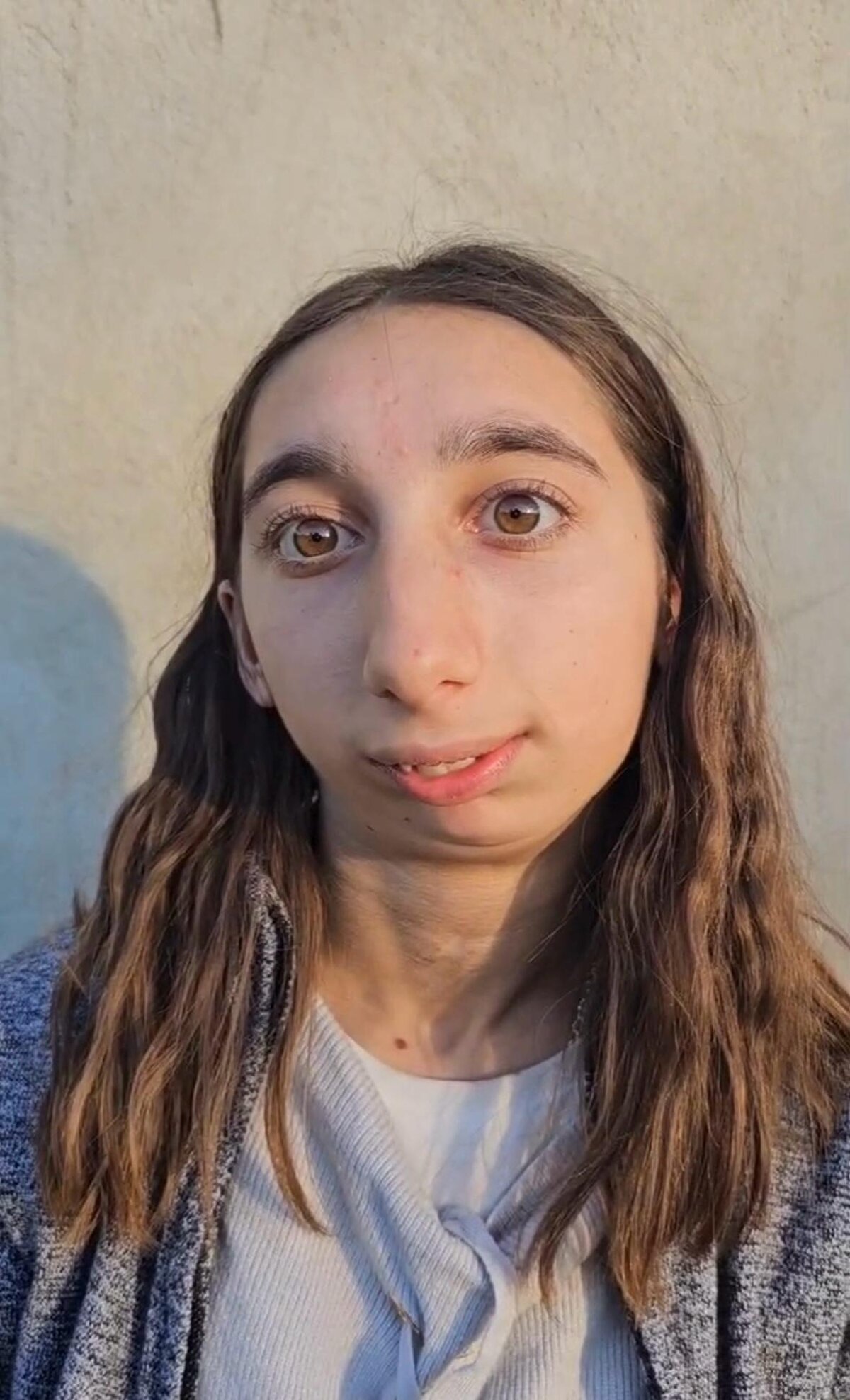 Gürcistan'da yaşayan Mariam Kokhreidze (16), 3 yaşında evde oyun oynarken talihsiz bir kaza geçirdi. Kaza sırasında çene kemiklerinde oluşan travmayla ağzını açamaz hale geldi. Nefes almakta, konuşmakta ve yemek yemekte zorlanan Kokhreidze, 8 yaşında ülkesinde ameliyat oldu ancak tedavisi olumsuz sonuçlandı. Diş doktoru olmak isteyen Kokhreidze, akran zorbalığı nedeniyle liseyi bitiremedi. Genç kadının yaşadığı zorluk sosyal medyada gündeme gelince Gürcistan’da haberlere konu oldu. Başlatılan yardım kampanyasında para toplanamayınca Ağız, Diş ve Çene Cerrahisi Uzmanı Prof. Dr. Altan Varol, ameliyatı ücretsiz gerçekleştirdi. Gelişim geriliği de yaşayan hatta 28 kiloya düşen Kokhreidze, İstanbul'da 7 saatlik bir operasyonla çenesine kişiye özel protez takılarak sağlığına kavuştu. Prof. Dr. Altan Varol ise sosyal medyada atılan mesajlarla Gürcistan’da adeta kahraman oldu.