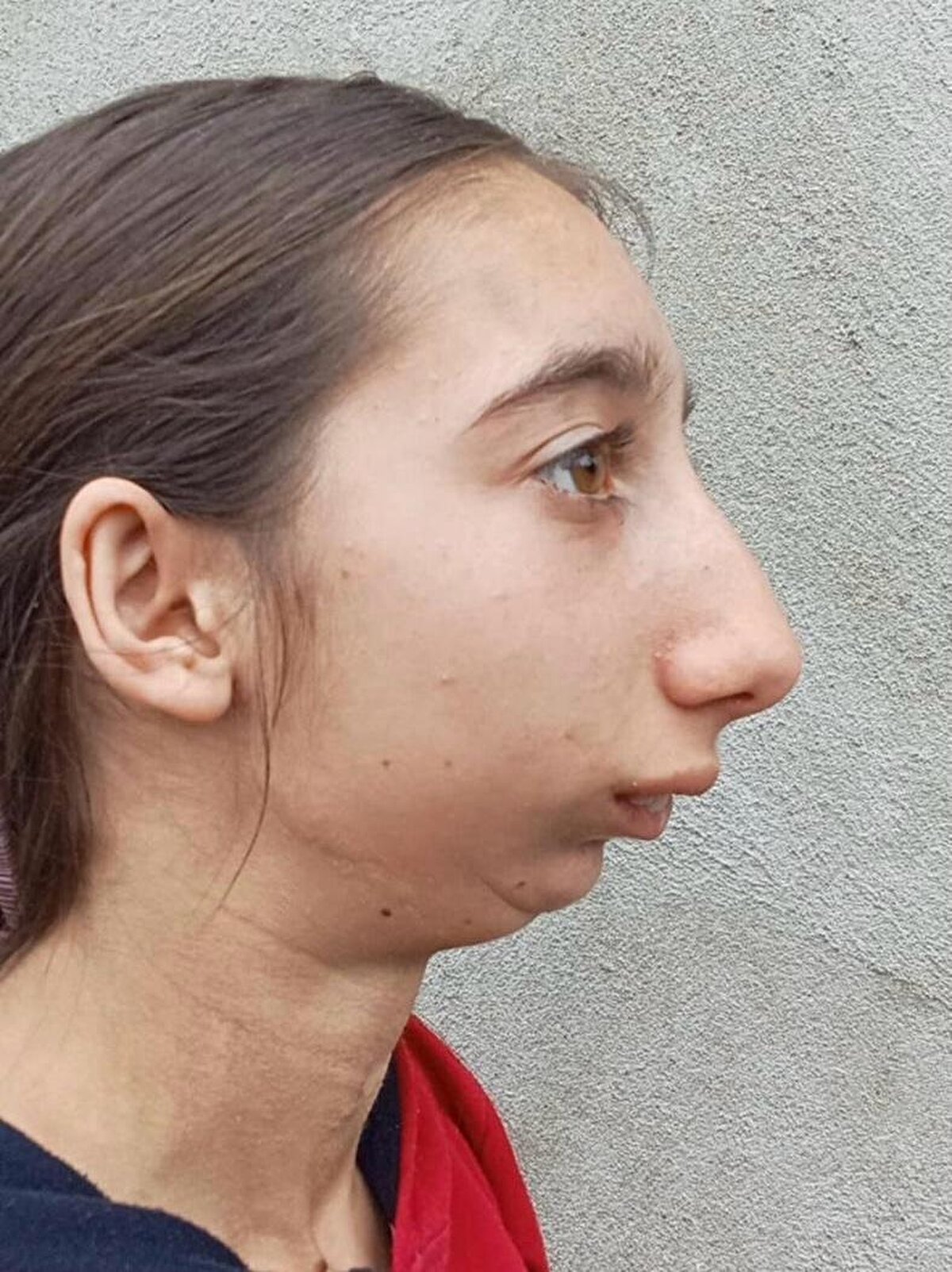 Mariam Kokhreidze, anne, babası ve kardeşleriyle Gürcistan’da bir köyde yaşıyordu. Üç yaşındayken oyun oynadığı sırada bir kaza geçirdi. Kaza sebebiyle yüzünde oluşan travmayla çenesini hareket ettiremez hale geldi. Çene ankilozu oluşan Mariam yemek yemekte, konuşmakta, hatta nefes almakta zorlanıyordu. Mariam, 8 yaşında ülkesinde ameliyat oldu, ancak başarılı bir sonuç alınamadı. Sağlık sorunlarına rağmen dokuzuncu sınıfa kadar okuyan Kokhreidze, bu yıl 16 yaşına bastı. Gelişim geriliği yaşayan, 16 yaşında olmasına rağmen 28 kilo ağırlığındaki genç kız, görünüşü sebebiyle uğradığı akran zorbalığına dayanamayarak okulunu bıraktı. Beş ay önce de Mariam’ın babası hayatını kaybetti.