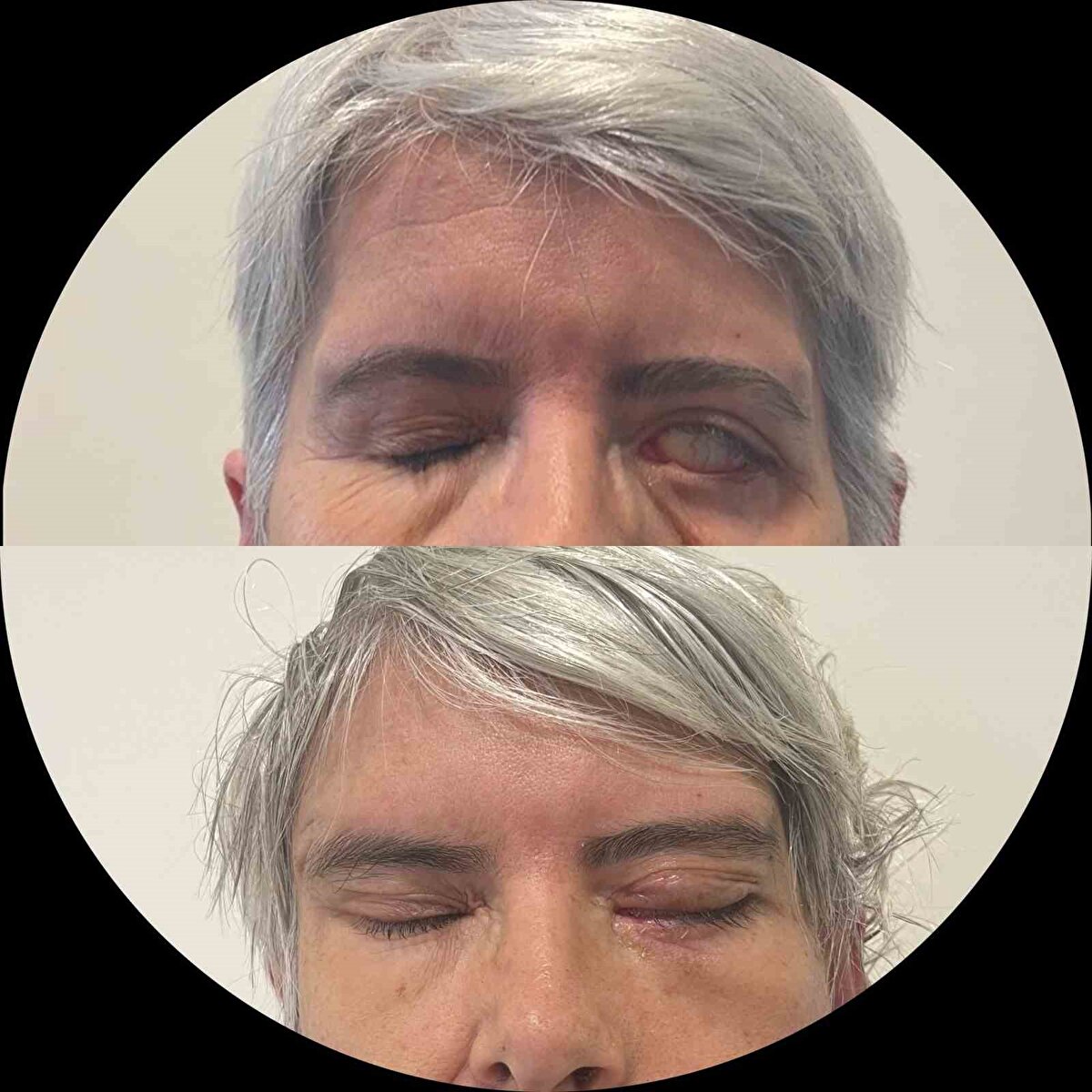 Tedavi sonrası her iki gözünü kapatarak uyuyabilen Cihan, gazetecilere yaptığı açıklamada, kendini dinlenmiş hissettiğini ve baş ağrılarının sonlandığını söyledi.