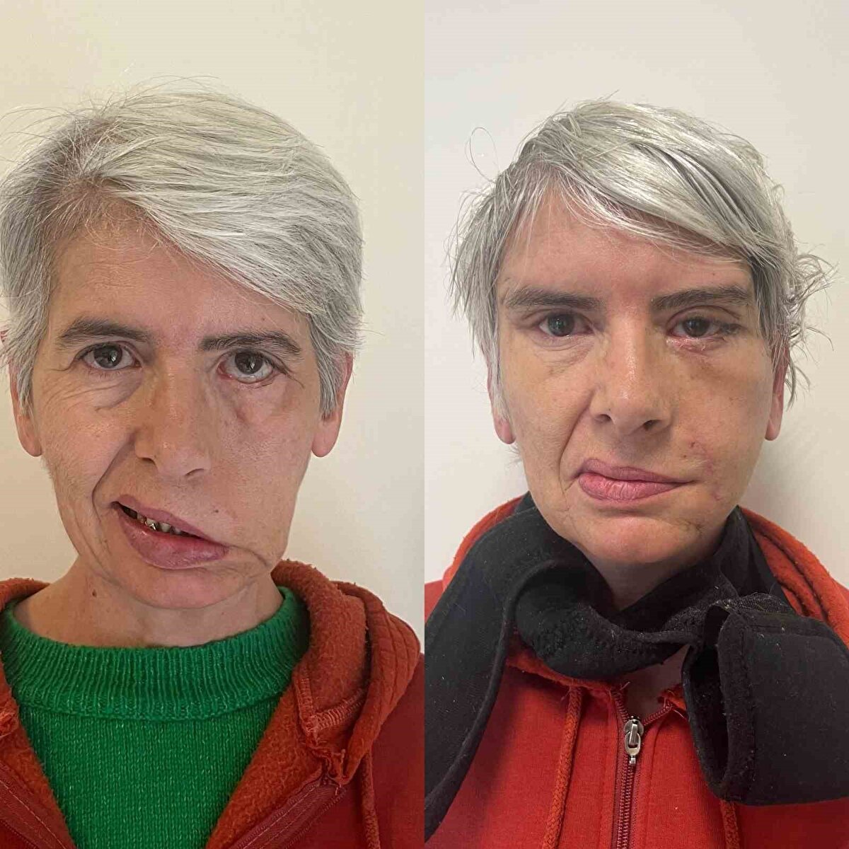 Yüz felcinin ardından sol gözünü kapatamayan ve yüz simetrisi bozulan bu nedenle açık gözle uyumak zorunda kalan Cihan, ablasının tavsiyesiyle Eskişehir Şehir Hastanesi'nde görev yapan Plastik Cerrahi Uzmanı Dr. Yunus Çınar'a başvurdu.