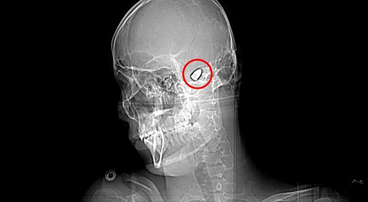 Halen sağ elini kullanmakta ve parmaklarımı oynatmakta zorlanan Yusuf, ölüm korkusu yaşadığını belirterek, "Hastanede başıma yorgun mermi isabet ettiği tespit edildi. Mermi riskli bir yerde olduğu için doktorlar çıkarılamayacağını söylediler. O andan itibaren benim için çok zorlu bir süreç başladı. Ellerimi hareket ettirmekte, yürümekte ve konuşmakta zorluk çekiyordum. 1,5 yıl boyunca yoğun bir fizik tedavi dönemin oldu.