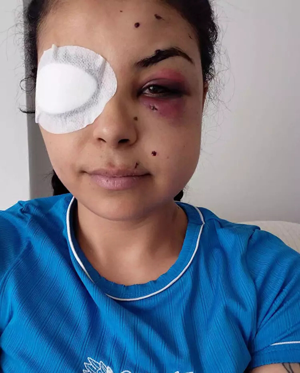 "Hayatım bitti"<br><br>Hastaneden çıktıktan sonra poliste ifade verip, ateş açan kişiden şikayetçi olduğunu anlatan Sepetçi, "Ateş eden şahıs da ifade vermiş, 'ben ateş etmedim, orada yoktum' demiş. Kendim gördüm kendisini, annem de gördü. Serbest bırakılmasına çok üzüldüm. 22 yaşındayım ve 4 yaşındaki oğlum da beni bu şekilde gördü. Şimdi çalışmama da etki edecek bu durum. Çalışamayacağım diye çok üzülüyorum. Ne yazık ki her düğünde böyle oluyor. Böyle bir şey yaşayacağımı hiç düşünmüyordum. O an kaç kez kelimeişehadet getirdiğimi bilmiyorum. 'Öleceğim' diye düşünüyordum, yaşayacağımı hiç düşünmedim. Ameliyat, çok riskli bir ameliyat. Ameliyat olsam bile gözüm görecek diye bir şey yok. Hayatım bitti bundan sonra. Sadece o şahsın ceza almasını istiyorum. Böyle elini kolunu sallayarak gezmesini istemiyorum" diye konuştu.