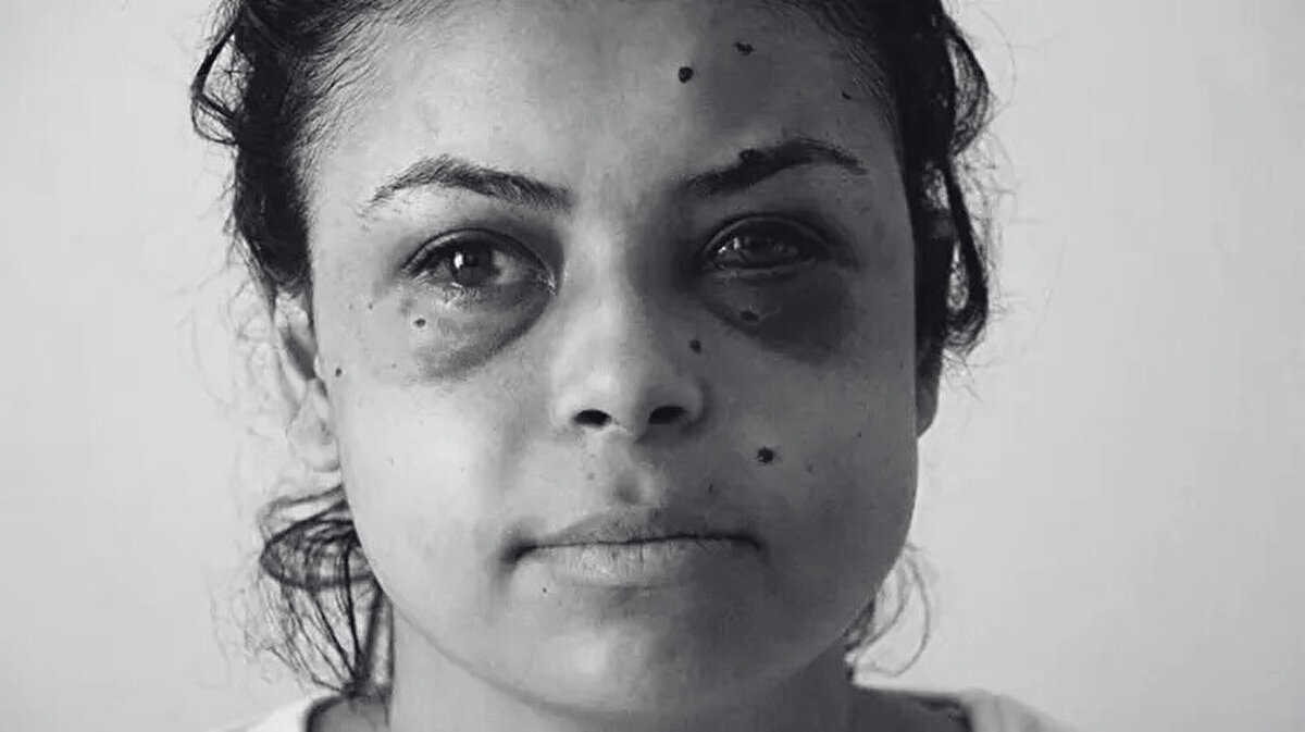 "Gözümü hastanede açtım"<br><br>Lüleburgaz'da bir markette çalışan Nazar Sepetçi, düğünü düzenleyenlerden kız tarafının kendi apartmanlarında oturduğunu belirterek, kendisinin de eğlenceyi pencereden izlediğini söyledi. Sepetçi, "O sırada kavga çıktı ve anneme balkondan çıkmasını söyledim. Ben de 'camı kapatayım' dedim, o sırada ateş sesi duydum ve gözüme geldi. Gözüme geldiği gibi yere düştüm ve sonrasını hatırlamıyorum. Buradan gittiğimde bilincim kapalıydı, gözümü hastanede açtım. Bir gözümün görmediğini söylediler. Ameliyat olacağım ama optik sinir zarar gördüğü için yüzde 100 açılacak diye bir şey yok. Şu anda bir gözüm yok" dedi.