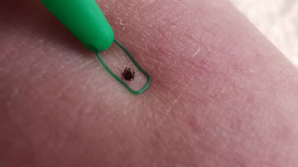 Keneler her zaman ölümcül olmasa da, taşıdıkları virüsler nedeniyle çok ciddi sağlık sorunlarına yol açabilirler. Kene ısırığına karşı bilinçli olmak, korunma yöntemlerini uygulamak ve doğru müdahale etmek hayat kurtarır. 2025’te yaşanan 18 ölüm, bu konuda ne kadar dikkatli olmamız gerektiğini bir kez daha gösteriyor.