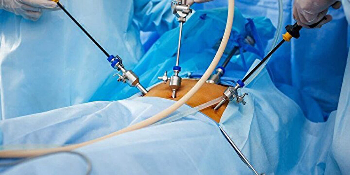 Laparoskopi, leğen kemiği organları ile karın içi organlarının cerrahi tedavisinde, geniş ameliyat kesileri kullanmadan, boyutları 1 cm ve daha küçük 3-5 kesi içinden borucuklar yerleştirme ile yapılan ameliyattır.<br>