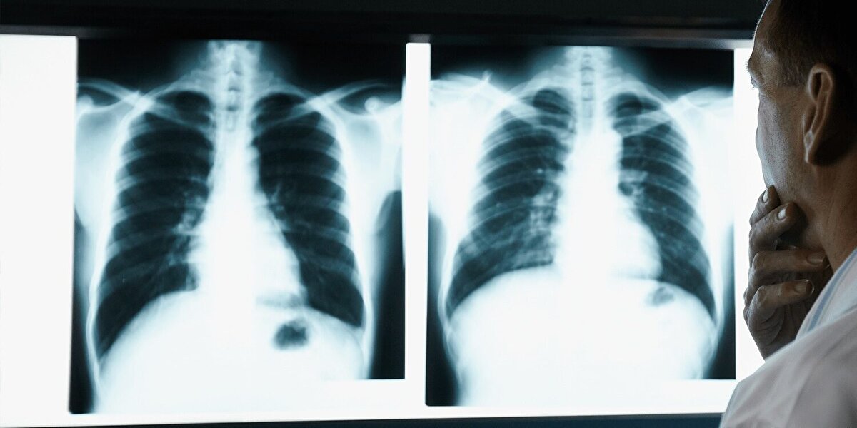 PM2.5 Partikülleri En Büyük Tehdit<br><br>Havadaki çapı 2.5 mikrometreden küçük olan PM2.5 partikülleri, insan vücudu tarafından filtrelenemiyor. Bu parçacıklar akciğerlerden kan dolaşımına geçerek yalnızca kanser değil, kalp hastalıkları ve DNA hasarına da yol açabiliyor.<br><br>Araştırmacılar ayrıca, kirli havaya maruz kalan bireylerde telomer adı verilen koruyucu DNA yapıların kısaldığını belirledi. Telomerlerin kısalması, yaşlanmayı hızlandırıyor ve hücre yenilenmesini olumsuz etkiliyor.