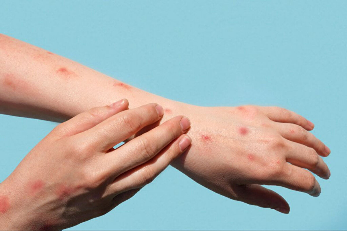 Chikungunya Türkiye’ye gelir mi? Risk var mı?<br> Çin’de chikungunya vakalarının yeniden görülmesiyle birlikte, Türkiye’ye yayılma riski de tartışılmaya başlandı. Türkiye’de özellikle Marmara, Ege ve Akdeniz gibi sıcak ve nemli bölgelerde Aedes türü sivrisineklerin görülmesi, virüsün yayılma ihtimalini artırıyor.<br>Her ne kadar şu ana kadar Türkiye’de herhangi bir chikungunya vakası bildirilmemiş olsa da, yaz aylarında artan sivrisinek popülasyonu ve uluslararası seyahatler nedeniyle bu riskin göz ardı edilmemesi gerekiyor. Halk sağlığı uzmanları, sivrisinek ısırıklarından korunmak için gerekli önlemlerin alınmasını ve yetkililerin durumu yakından izlemesini öneriyor.