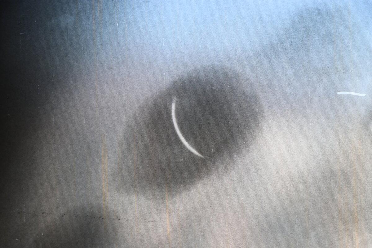 "Kimse o riski almak istemiyor"<br><br>Karnındaki iğneyi alacak doktor bulamadığını belirten Tanyıldız, şöyle konuştu:<br><br>“İğne 22 yıldır çıkarılmadı. Riskli olduğu için çıkaramıyorlar. Kanamayı durduramayacakları için, iğne ciğerimde geziyor. Açınca iğneyi bulamayacakları için, kimse o riski almak istemiyor. İnşallah bir doktor çıkar. Beni bu sıkıntıdan, 22 yıllık çektiğim çilelerden kurtarırsa çok mutlu olurum, dua ederim.” 