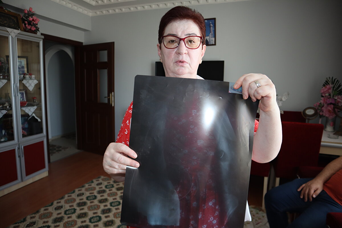 Kendisini özel hastanede ameliyat eden Genel Cerrahi Doktoru İ.D.’ye dava açan Tanyıldız, ağrılarının nedeninin karnında unutulan ameliyat iğnesi olduğunu öğrendi. 19 yıl sonra mahkemesi de sonuçlanan Tanyıldız, bir miktar tazminat almaya hak kazandı. 22 yıldır ameliyat iğnesiyle yaşayan Tanyıldız, “2003 yılında ameliyatım yapıldı. Karaciğerimdeki kistten dolayı ameliyat oldum. Karaciğerimde kist oluşmuş. Kisti alırken ameliyat iğnesini unutmuşlar. 6 yıl sonra fark ettim. İlk öğrendiğimde başka doktora gittim, böbreklerimden rahatsızlanmıştım. Doktor film çekince ‘sen MR’a girme, ciğerinde iğne var’ dedi. O zaman fark ettim. Fiziksel olarak hala ağrısını, yıllardır çekiyorum” diye konuştu.