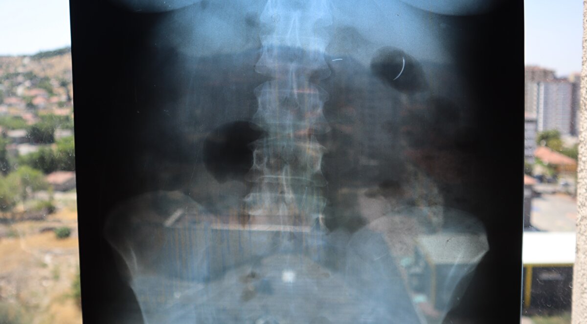 Kentte yaşayan 2 çocuk annesi Ayhan Tanyıldız, 2003 yılında karaciğerindeki kist nedeniyle ameliyat oldu. Ameliyat olduktan 6 yıl sonra böbrek rahatsızlığı nedeniyle hastaneye giden Tanyıldız’ın çekilen röntgeninde iğne görüldü. Tanyıldız’ın kist ameliyatı sırasında karnında ameliyat iğnesi unutulduğu ortaya çıktı.