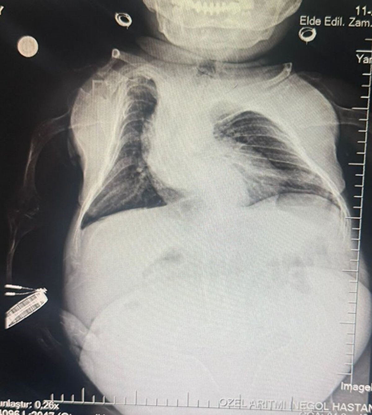 Kadın Hastalıkları Uzmanı Mustafa Kır, "Hastamızda 20 santimlik tümör vardı kistlik yapıda. Onu başarılı bir operasyonla çıkarttık" şeklinde konuştu.