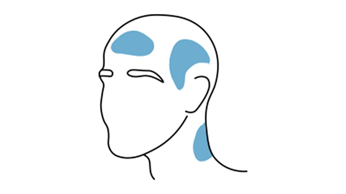 Travma sonrası baş ağrısı<br><br>Şakaklarda, alında ve boyunda sıkça görülür