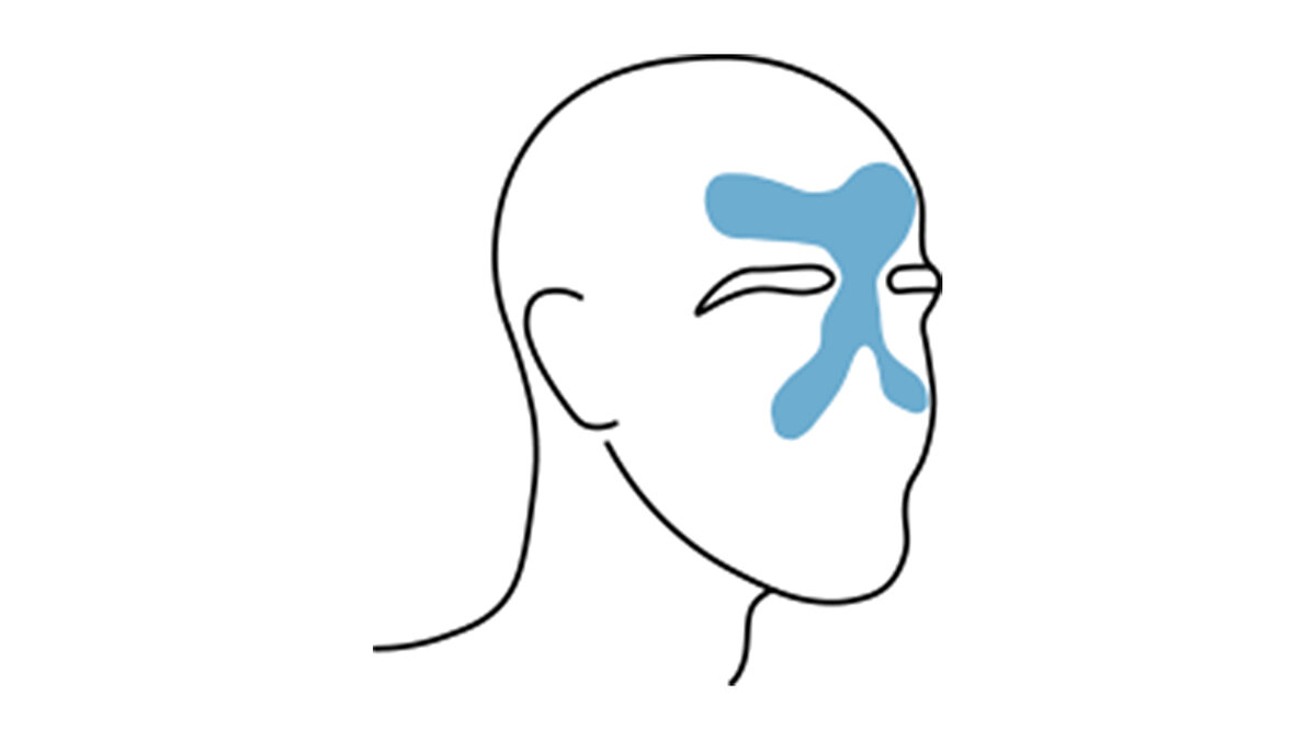 Sinüzit baş ağrısı<br><br>Alın bölgesinde, elmacık kemiklerinde ve burun boşluğunda hissedilir