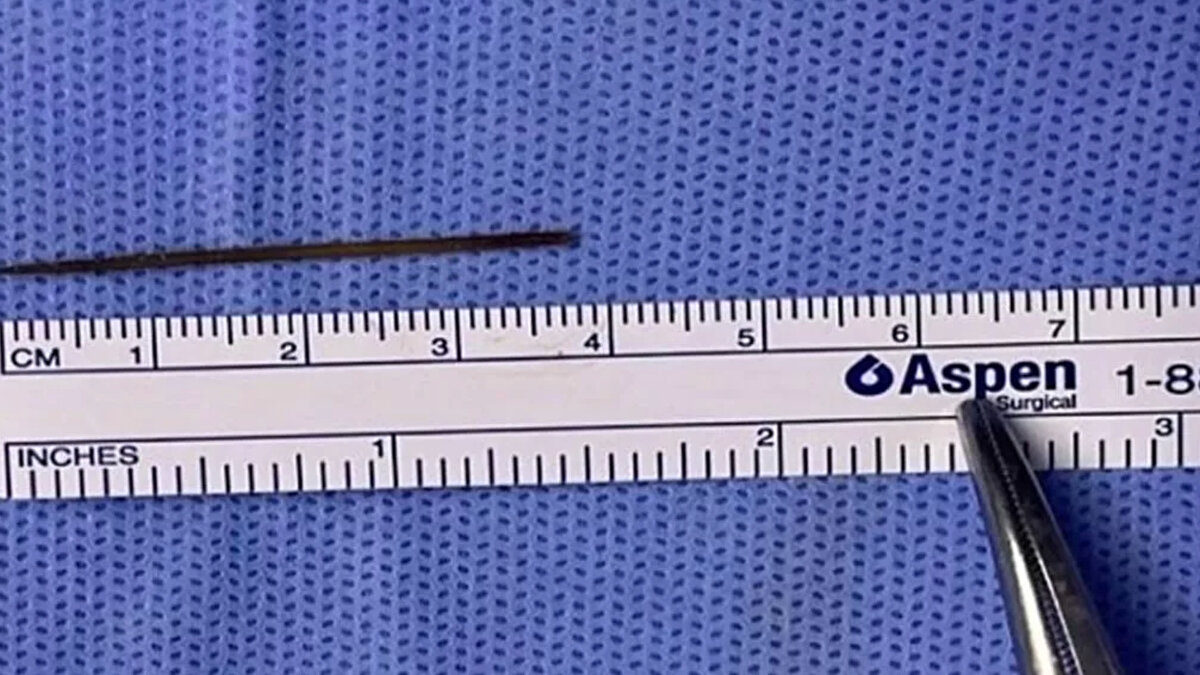 Ameliyatı başarılı geçti<br><br>Başarılı bir ameliyat geçiren hasta, hastanede 3 gün gözetim altında tutulduktan sonra taburcu edildi. Sağlık durumunun iyi olduğu öğrenildi.