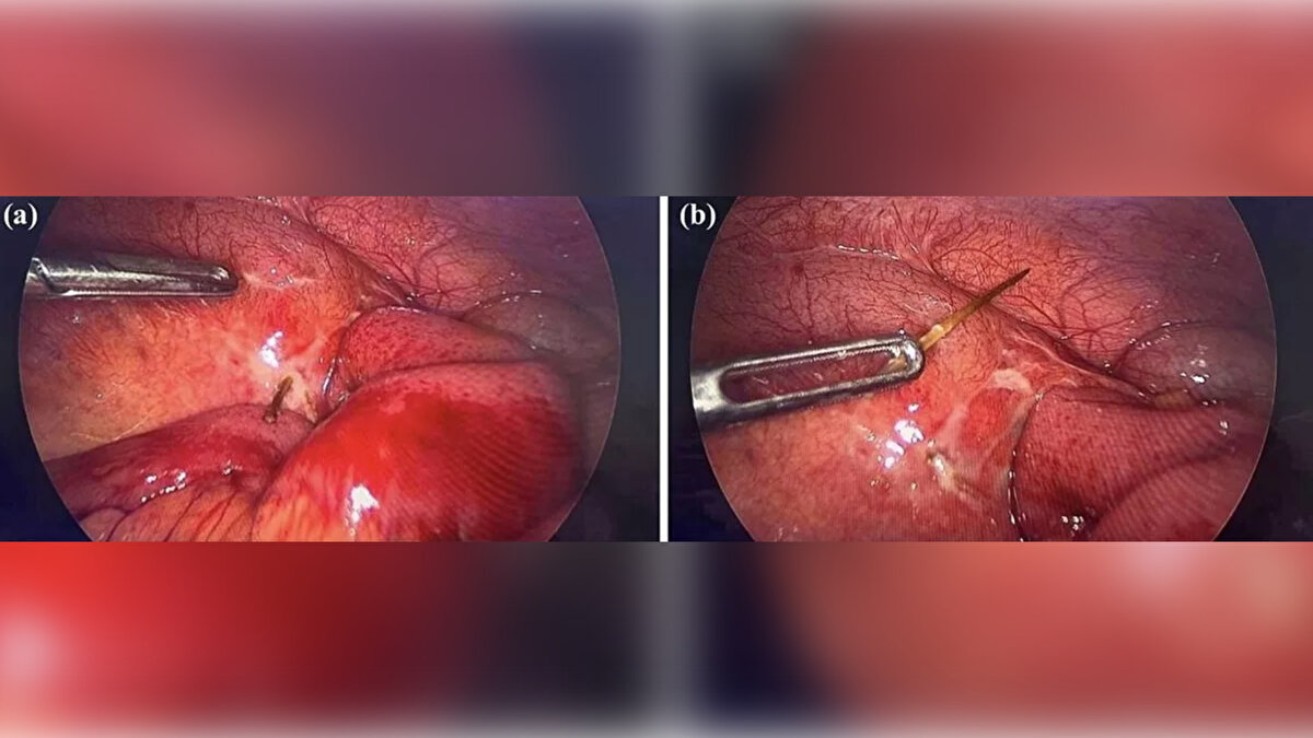 Mirror'un haberine göre, 29 yaşındaki adamın bağırsaklarında 3,7 cm uzunluğunda sivri bir cisim tespit edildi. Yemeğin içerisine fark edilmeden düşmüş bir tavuk kemiği zannedilen cismin ameliyat sonrasında kürdan olduğu anlaşıldı. Suudi vatandaş, bir gün önce ağzında kürdanla uyuyakaldığını ve muhtemelen uykusunda kürdanı yuttuğunu belirtti. 