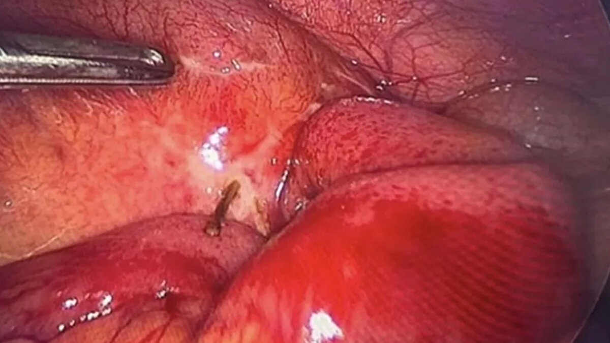 Suudi Arabistan'da yaşanan olay, doktorları ve sosyal medya kullanıcılarını şaşkına çevirdi. 29 yaşındaki bir adam, akşam yemeğinde tavuk yedikten sonra bir süre sonra şiddetli karın ağrısıyla hastanenin yolunu tuttu. Yapılan ilk tetkiklerde herhangi bir probleme rastlanmazken istenilen tomografi sonucunda gerçek ortaya çıktı. 