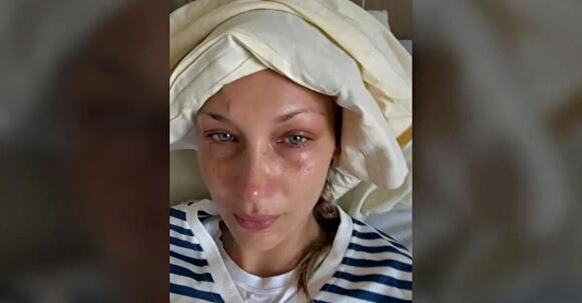 Bella Hadid yıllardır bu hastalıkla mücadele ederken zaman zaman sosyal medya üzerinden tedavi sürecini paylaşarak farkındalık yaratıyor. Lyme hastalığında erken teşhis ve antibiyotik tedavisi büyük önem taşıyor. Ancak bazı vakalarda semptomlar uzun yıllar devam edebiliyor.