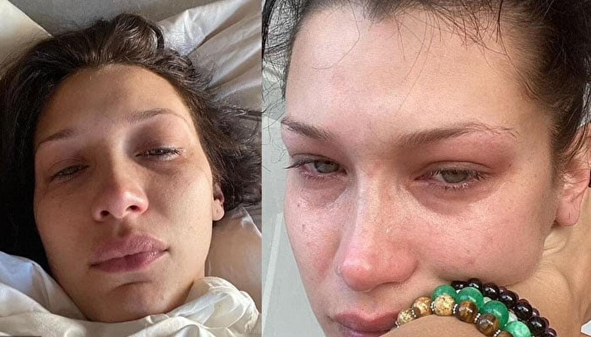 İlk evrelerinde grip benzeri belirtilerle ortaya çıkan Lyme hastalığı, tedavi edilmediğinde sinir sistemi, kalp ve eklemler üzerinde ciddi sorunlara yol açabilir. Baş ağrısı, kas-eklem ağrıları, ateş, yorgunluk ve ciltte halkalı döküntüler en sık görülen belirtiler arasında yer alıyor.