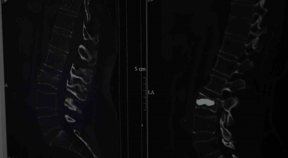 Burada Beyin ve Sinir Cerrahisi Uzmanı Doç. Dr. Şevket Evran ve ekibinin yaptığı incelemelerde kemik erimesine bağlı kırık tespit edildi. Armağan, durumu şaşkınlıkla karşılarken doktorlar operasyon gerekliliğini ifade etti. Genellikle kemik erimesine bağlı omurga kırıklarını tedavi etmek amacıyla uygulanan minimal invaziv bir cerrahi yöntem olan ve hastanın aynı gün normal yaşamına dönebilme imkanı sunan kifoplasti operasyonu 25 Ağustos günü gerçekleştirildi. Doç. Dr. Evran ve ekibinin yaptığı operasyon başarılı geçerken Armağan da rahat bir nefes aldı. Doç. Dr. Evran, özellikle menopoz sonrası kadınlarda kemik erimesi kaynaklı oluşan kırıklarına dikkat çekerken tedavilerine ilişkin bilgi verdi, vatandaşlara önemli uyarılarda bulundu.