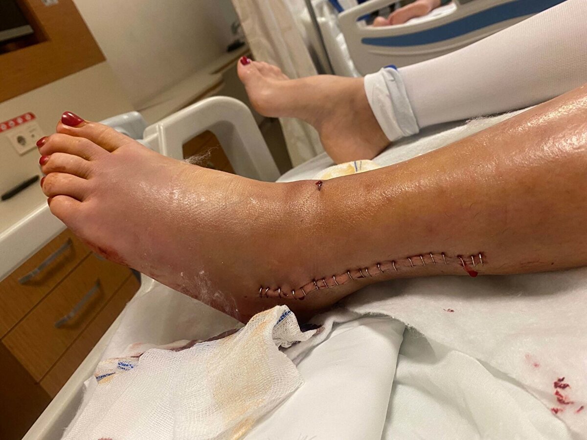 İzmir’in Menemen ilçesinde Hamit Göksel Yılmaz (44), şiddet nedeniyle kendisinden boşanan Hatice Ekiz’e (37) çocuğunun gözü önünde otomobille çarptı. Ağır yaralanıp, hastanede tedaviye alınan Hatice Ekiz, "Boşandık, hiçbir mal varlığına dokunmadım. Hayat mücadelesi veriyorken bir de şimdi sakat kaldım. Kadın kuaförüyüm, ayakta çalışıyorum ama artık ayağım iş göremeyecek halde. En ağır cezayı almasını istiyorum. Çıktığı anda daha fazlasını yapacak. Korkmuyor. Çıkarsa beni öldürmeye niyetlenecek. Çocuğuna acımayan bana mı acıyacak? Ölmek istemiyorum" dedi.