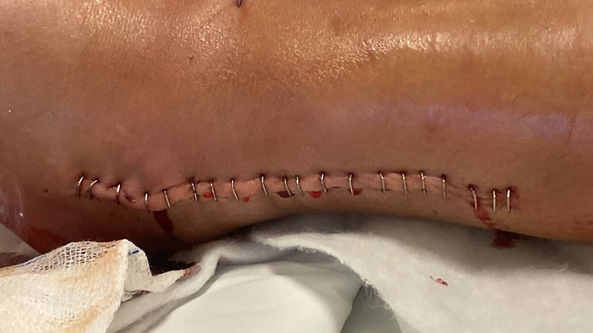 Olay, 2 Kasım’da Menemen ilçesinde meydana geldi. Hamit Göksel Yılmaz, ters yöne girip otomobiliyle iş yerinden çıkıp 2 çocuğuyla yolda yürüyen eski eşi Hatice Ekiz’e çarptı. Yere düşen Ekiz’in yanına gelen Yılmaz’ın, “Çocuklara dua et, seni öldürmedim, ayağını ezdim” dedikten sonra uzaklaştığı belirtildi. İhbar üzerine adrese polis ve sağlık ekipleri sevk edildi. Ambulansla hastaneye kaldırılan Hatice Ekiz’in ayak bileği ve kaburgasında kırıklar oluştuğu belirlendi. Ekiz’in bacağındaki hasarın kalıcı olabileceği ve sakat kalma riski bulunduğu ifade edildi.