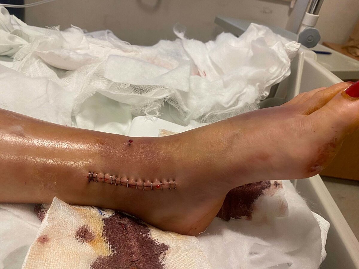 Hatice Ekiz, sözlerini şöyle sürdürdü:<br><br>"Boşandık, hiçbir mal varlığına dokunmadım. Hayat mücadelesi veriyorken, bir de şimdi sakat kaldım. Kadın kuaförüyüm, ayakta çalışıyorum ama artık ayağım iş göremeyecek halde. En ağır cezayı almasını istiyorum. Çıktığı anda daha fazlasını yapacak. Korkmuyor. Çıkarsa beni öldürmeye niyetlenecek. Çocuğuna acımayan bana mı acıyacak? Söyleyecek bir şey bulamıyorum. Ölmek istemiyorum. Tedavi olması lazım, hasta. Kadınlar korunamıyor. Bu şekilde nasıl olacak? En hafif cezaları alıyorlar. Haberlerde görüyoruz, maalesef her gün bir kadın daha öldürülüyor. Ailesine, ailelerimize söylüyoruz, olmuyor. Takıntılılar, psikolojileri iyi değil."