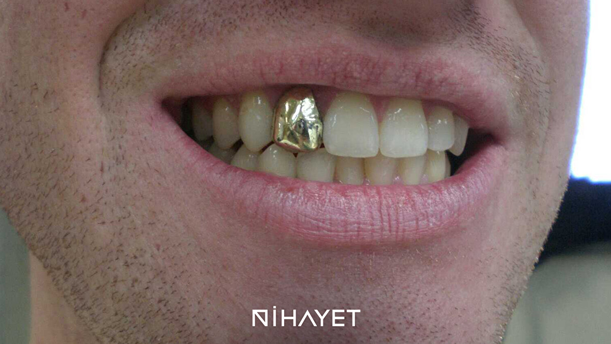 Altın Diş<br><br>2013 yılında, devlet başkanı tarafından gençlere altın diş taktırmak yasaklanmıştır