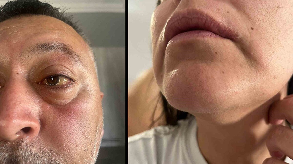 "Yaşadıklarımız insan haklarına yasalarına aykırı"<br><br>Emin Yoldaş’ın eşi Sema Çelikkaya Yoldaş ise, Ayvalık Gümrüğü ‘nden geçerken hakları olan üç karton sigara satın aldıklarını belirterek, "Arabada üç kişiydik. Midilli’ye giderken feribotta bir karton sigarayı arkadaşlarıma dağıttım. Geriye kalan iki karton sigarayı da çantalarım çok dolu olduğu için açıp, çantalarıma gelişigüzel bir şekilde koydum. Midilli’de gümrükten geçtikten sonra Gümrük Müdürü Katarina Apostolidou, sahada arabamızı aramaya başladı. Ben doğru beyanda bulunarak, Ayvalık’tan çıkarken üç karton sigara aldığımı söyledim. Yaptığı bu alışverişin fişini de ibraz ettim. Arabadan valizlere paylaştırdığım 19 paket sigara çıkarttılar. Çantamda da üç paket vardı. Toplamda 22 paketti. Normalde prosedür gereği yapmaları gereken, sigaralara el koyulup, idari para cezası keserek bizi yollamaları gerekirken bize; karşı çıkma direnme ve kaçakçılık olduğunu beyan ettikleri için savcılık polisi geldi bizi kelepçeli bir şekilde gözaltına aldılar. Biz bir gece nezarethanede kaldık. Nezarethane çok kötü şartlar altındaydı. Ama ben, Yunan polislerin suçlamıyorum. Çünkü orada mevzuatı; direnme, karşı koyma kaçakçılık olarak geçtikleri için onlarda yapmaları gerekeni yaptı. Nezarethanede oturulan alan taş ve üzerinde bir sünger vardı. Bu süngerin üstü çok çok pisti. Nezarethane çok soğuktu. Yemek ihtiyacımız oldu. Eşimin şeker hastası olduğunu söyledim. Fakat yemek vermek yerine, 20-25 Euro arası bir para verdiler ve ‘yarın bununla yemek yersiniz’ dediler. Nezaret süresince bize kesinlikle yemek verilmedi. Suyu da saat 02.30’da benim yalvarmalarım sonucunda bir polis memuru bize sağladı. Tuvalete ihtiyaçlarımızı da çok geç giderildi" dedi.