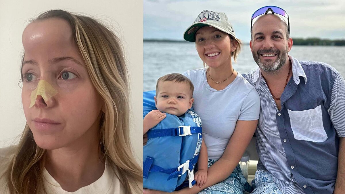 “Yeni burnuma dokununca alnımda hissediyordum”<br><br> Wilson, iyileşme döneminde yaşadığı tuhaf hislerden de bahsetti. Burnuna dokunduğunda alnında bir his oluştuğunu ve bu hissin zamanla kaybolduğunu dile getirdi. Operasyonlara rağmen baş bölgesinde hâlâ uyuşma ve ağrı karışımı bir durum yaşadığını belirten Wilson, önünde en az üç ameliyat daha bulunduğunu ifade etti.