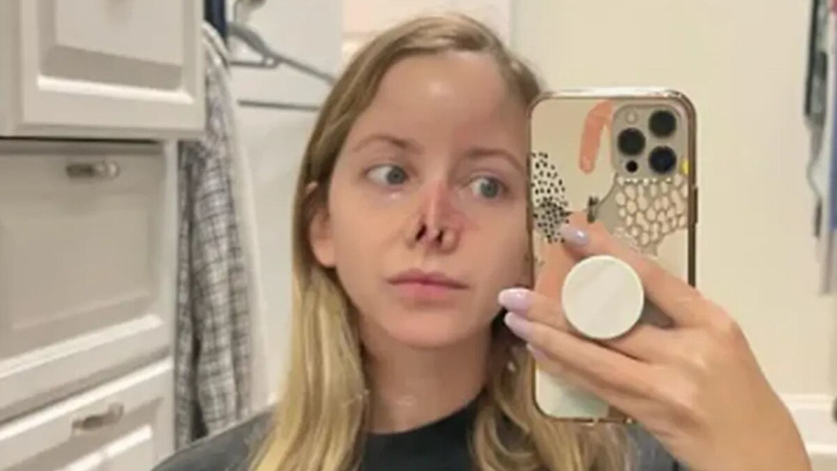 Saldırı sonrası yüzündeki değişim nedeniyle uzun süre insan içine çıkmakta zorlandığını söyleyen Wilson, “Dışarı adım attığım her an insanların bana baktığını düşünüyordum” dedi. Yeni burnunun görünümünden memnun olduğunu belirten genç kadın, mizahi bir dille burun deliklerinin darlığı nedeniyle “artık burnumu karıştıramadığını” söyledi.