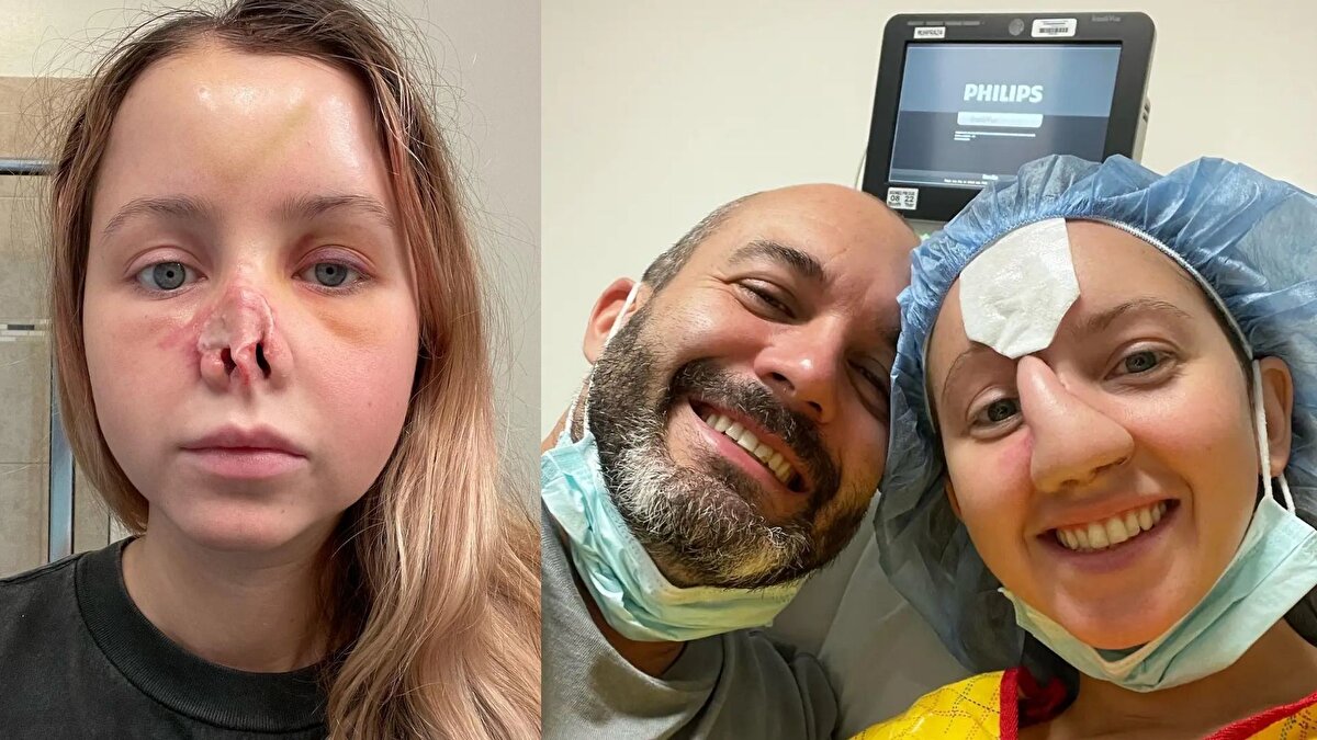 Doktorlar, Wilson’ın kaybettiği burnu yeniden oluşturmak için kapsamlı bir rekonstrüksiyon süreci uyguladı. Önce alın bölgesine yerleştirilen doku genişleticilerle yeni burun için yeterli deri oluşturuldu. Bu süreçte alın bölgesinde büyük şişlikler meydana geldi. Ardından alınından alınan doku, genç kadının yüzüne nakledilerek yeni bir burun şekillendirildi.