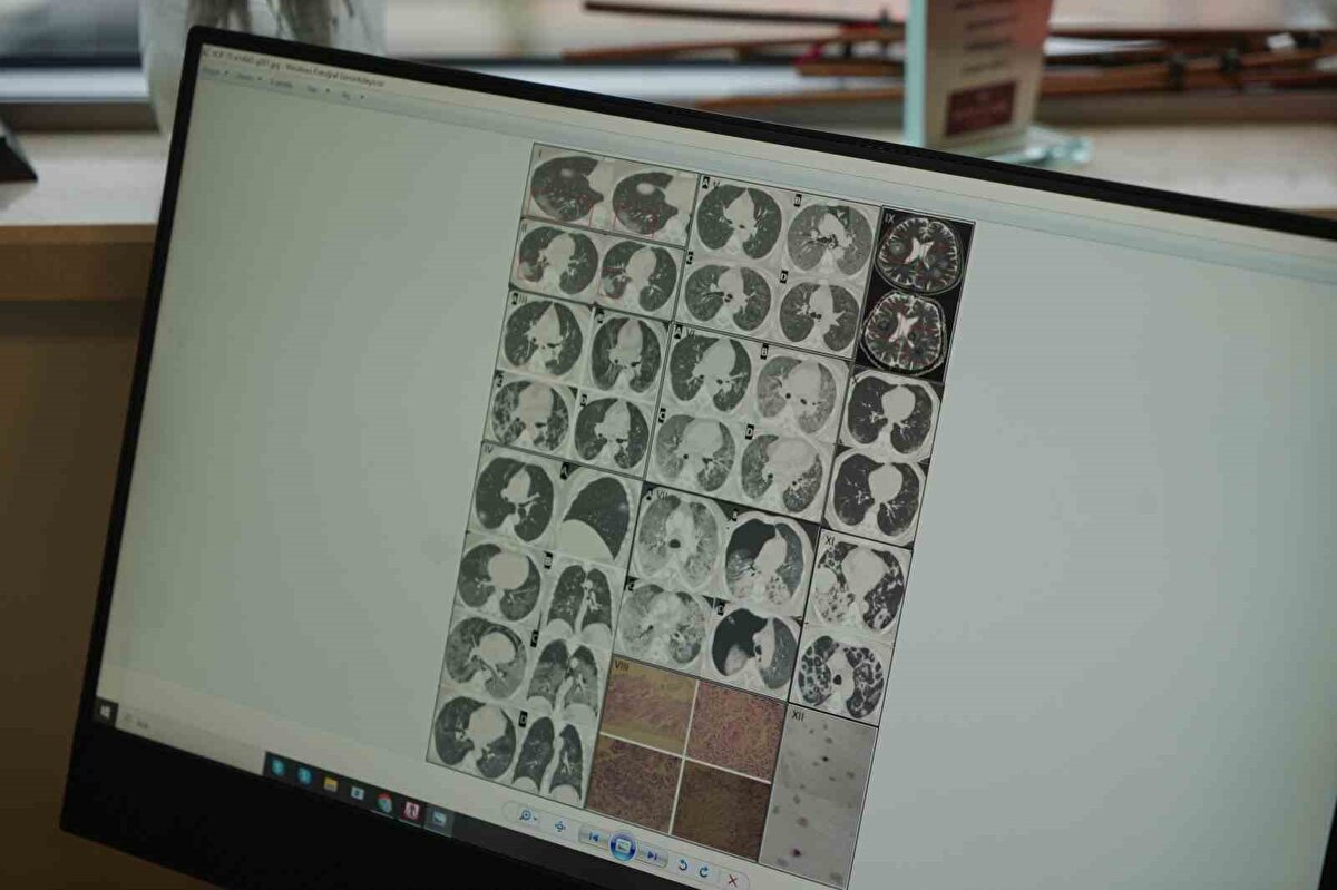 Pandemi sonrası gençlerde yaşanan ani ölüm vakalarının arttığına dikkat çeken Göğüs Hastalıkları Uzmanı Prof. Dr. Şevket Özkaya, Kovid-19 enfeksiyonunun özellikle damar iç yüzeyinde kalıcı izler bıraktığını belirtti. Uzun süreli damar hasarının, spor yapan kişilerde beklenmedik kalp sorunlarını tetikleyebildiğini ifade etti.