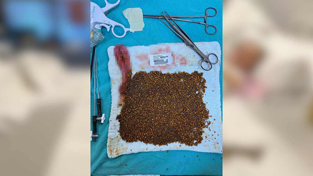 Hastane yönetimi operasyonu ‘örnek vaka’ olarak niteledi<br><br>Operasyon sonrası değerlendirme yapan Soma Devlet Hastanesi Başhekimi Gökhan Kıvanç Yaşar, başarılı müdahalenin deneyimli cerrahlar ve güçlü ekipman sayesinde mümkün olduğunu belirtti. Nadir vakalarda erken tanının önemine dikkat çeken Yaşar, hastanenin bölgeye nitelikli sağlık hizmeti sunmaya devam edeceğini söyledi.