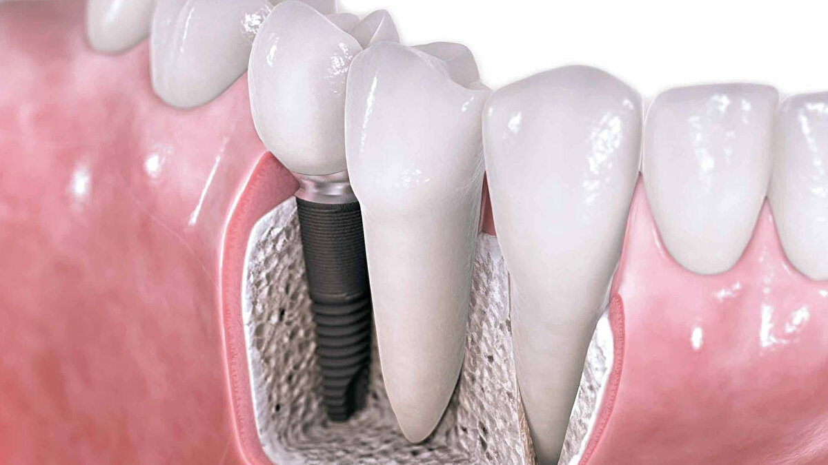 "Bilhassa emekli vatandaşlarımızın sağlık hizmetlerinden daha geniş bir kapsamda yararlanabilmeleri için hamdolsun gerekli kaynaklarımız da var. Başta emeklilerimizin durumunu düşünerek tüm vatandaşlarımız için ağız ve diş sağlığı kapsamında ihtiyaç duydukları İMPLANT TEDAVİSİ için yerli üretim ve en fazla 4 adet olmak üzere yapılacak tüm uygulamaların kurum tarafından karşılanmasını önerdik."