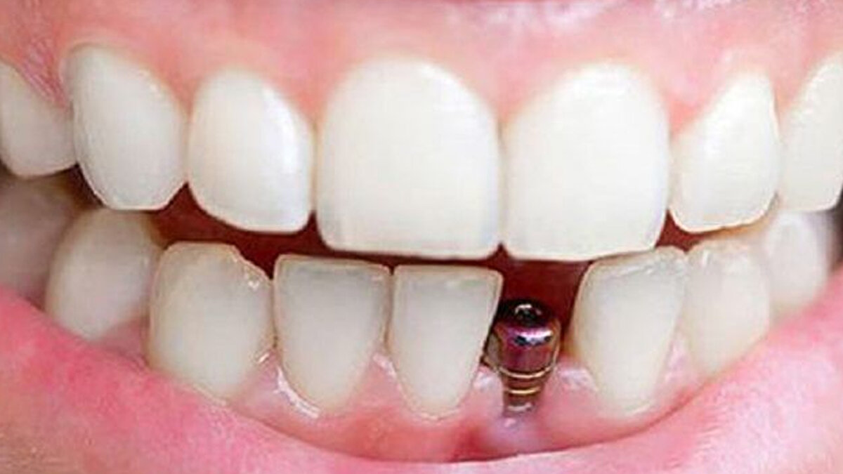 Yüksek maliyetleri nedeniyle vatandaşların, özellikle de emeklilerin yaptırmakta zorlandığı implant tedavisi için MHP harekete geçti. Kayseri Milletvekili İsmail Özdemir tarafından hazırlanan kanun teklifi ile implantın Sosyal Sigortalar Kurumu (SSK) tarafından karşılanması önerildi.