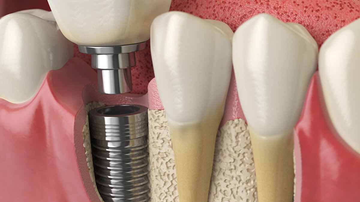 Şartlar Belli Oldu: Yerli Malı Olacak!<br><br>MHP'li Özdemir'in TBMM'ye sunduğu teklifte, devletin ödeme yapması için kritik iki şart yer aldı. Buna göre;