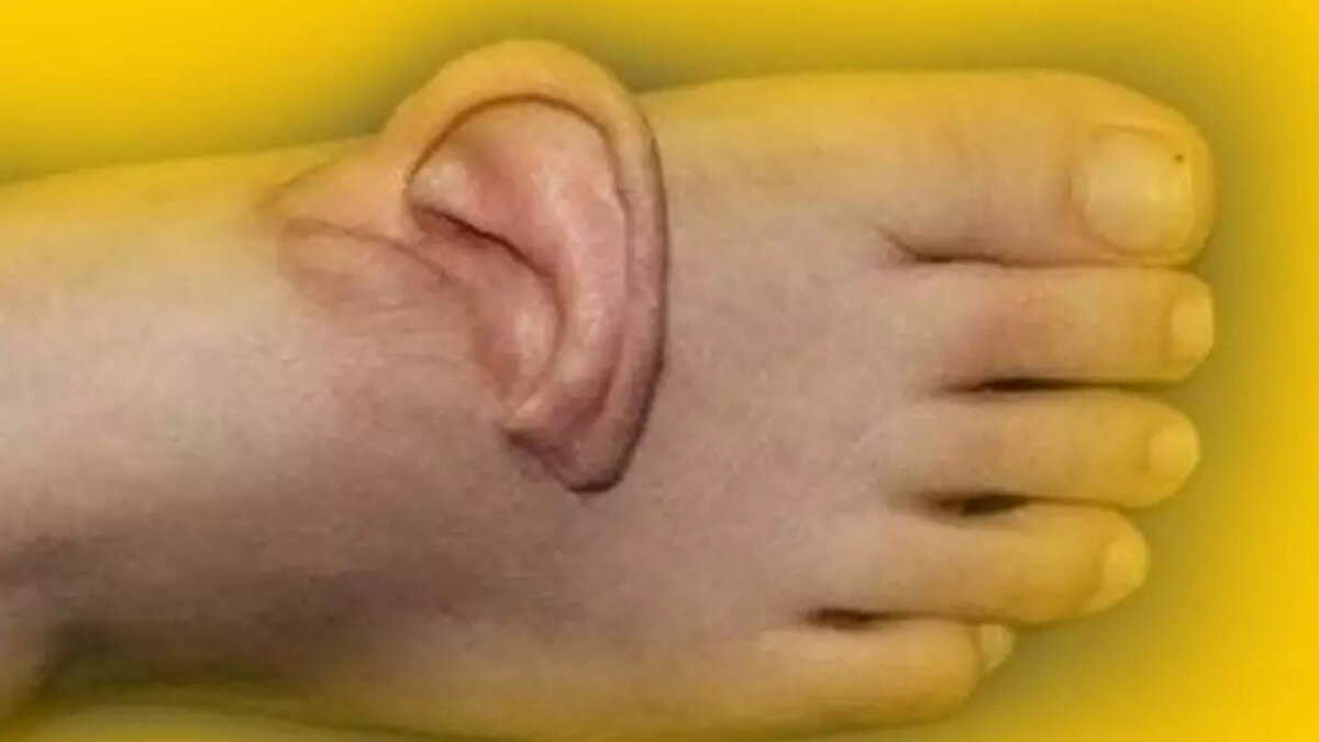 İkinci operasyonla kulak eski yerine nakledildi<br><br>Ekim ayında gerçekleştirilen ikinci ameliyatta, cerrahlar kulak dokusunu ayaktan alarak yeniden baş bölgesine nakletti. Kazada zarar gören sinir ve damarları bulmak için mikroskop altında katman katman çalışan ekip, tüm bağlantıları yeniden kurmayı başardı.<br>Beş ay süren olağan dışı tıbbi süreç sonunda, hastanın kulağı işlevsel şekilde yerine yerleştirildi.