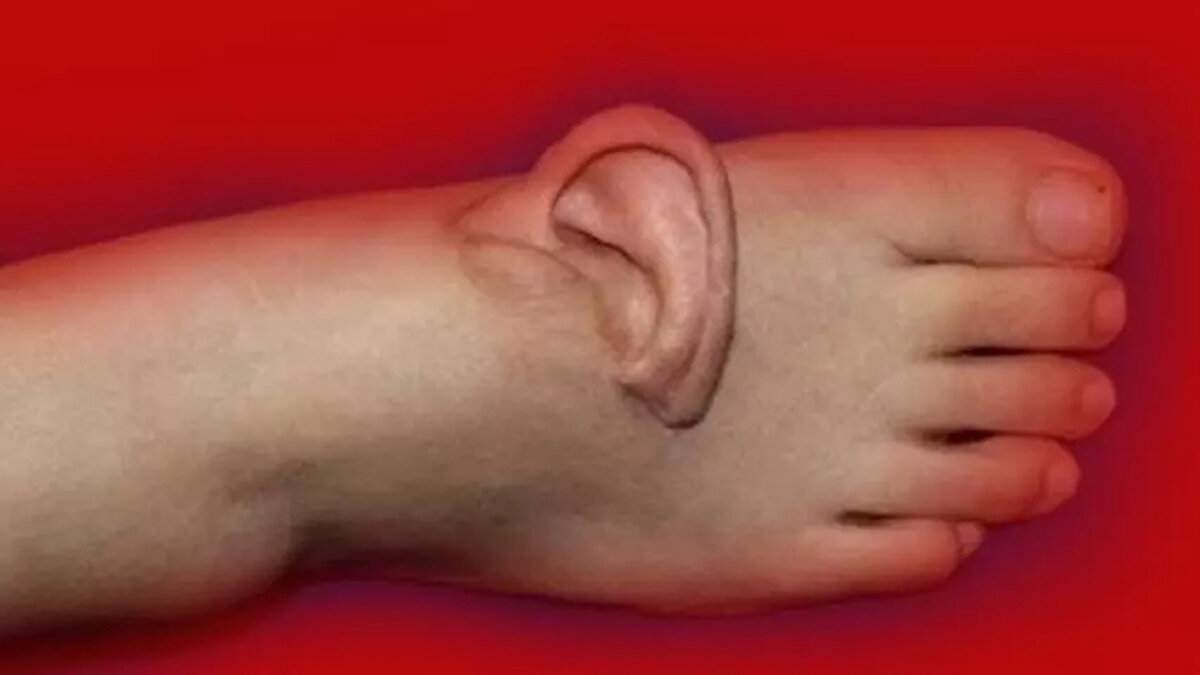 Beş aylık bekleme süreci: Doku yeniden canlandı<br><br>Operasyonun ardından kan akışı tam sağlanamayınca ek müdahaleler yapıldı. Doku tutmaya başladıktan sonra kulak ayak bölgesinde beş ay boyunca beslendi. Kadın, bu süreçte kulağa zarar vermemek için yalnızca gevşek ayakkabılar giyerek kontrollü yürüyüşler yaptı. Aynı dönemde başındaki diğer yaralar da iyileşerek ikinci operasyon için uygun hale geldi.