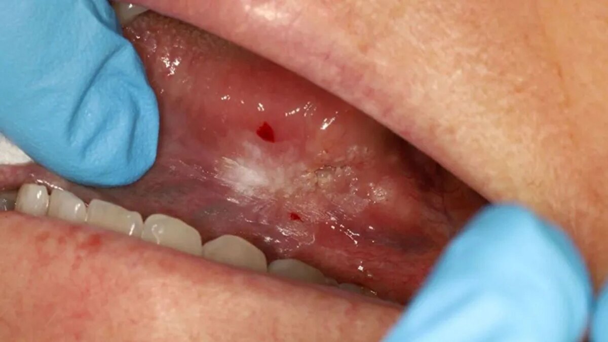 Tanı ve cerrahi müdahaleler <br><br>Artan şiddetteki ağrı nedeniyle özel bir ağız ve çene cerrahı danışmanına başvuran Blair, biyopsi olmadan tek bakışta skuamöz hücreli karsinom teşhisi aldı. Takip testleri arasında MRI ve CT taramaları yer aldı. Glasgow’daki Queen Elizabeth Üniversitesi Hastanesi’nde ilk cerrahi müdahale ile kanser ve lenf düğümleri çıkarıldı, ancak patoloji raporu kanserin yayıldığını gösterdi. Bunun üzerine Blair’in dilinde ikinci bir ameliyat yapıldı ve boynundaki kanserli lenf düğümleri de alındı.