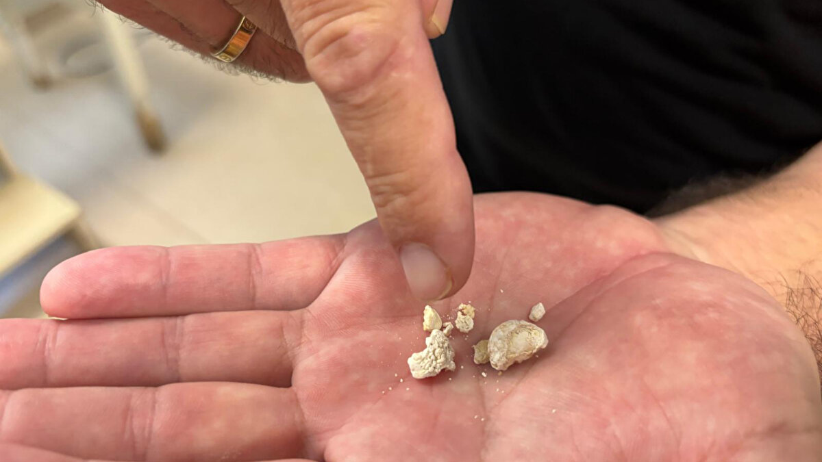 Antalya Eğitim ve Araştırma Hastanesi’nde yapılan tetkiklerde, Metin Paçacı’nın tükürük bezinde çok sayıda taş bulunduğu belirlendi. Yapılan incelemeler sonucunda, bezin taşlara bağlı olarak büyüyerek kitle haline geldiği tespit edildi. Hastanın şikâyetlerinin artması üzerine cerrahi müdahale kararı alındı ve yaklaşık iki saat süren operasyon gerçekleştirildi.