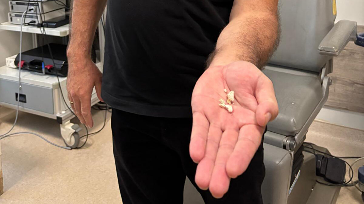 Gecikme enfeksiyon riskini artırdı<br>Yetkililer, şikâyetlerin uzun süre devam etmesi nedeniyle hastada sık enfeksiyon atakları yaşandığını aktardı. Bu durumun cerrahi işlemi zorlaştırdığı ifade edilirken, ameliyatın ardından hastanın beslenme ve günlük yaşamla ilgili sorunlarının ortadan kalktığı kaydedildi.<br><br>Operasyon sonrası açıklama yapan Metin Paçacı ise uzun süredir yaşadığı ağrı ve rahatsızlığın sona erdiğini belirterek, ameliyatın ardından rahatladığını söyledi.