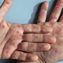 Dünyayı tehdit eden Marburg virüsü: Yaygın kanama görülebiliyor